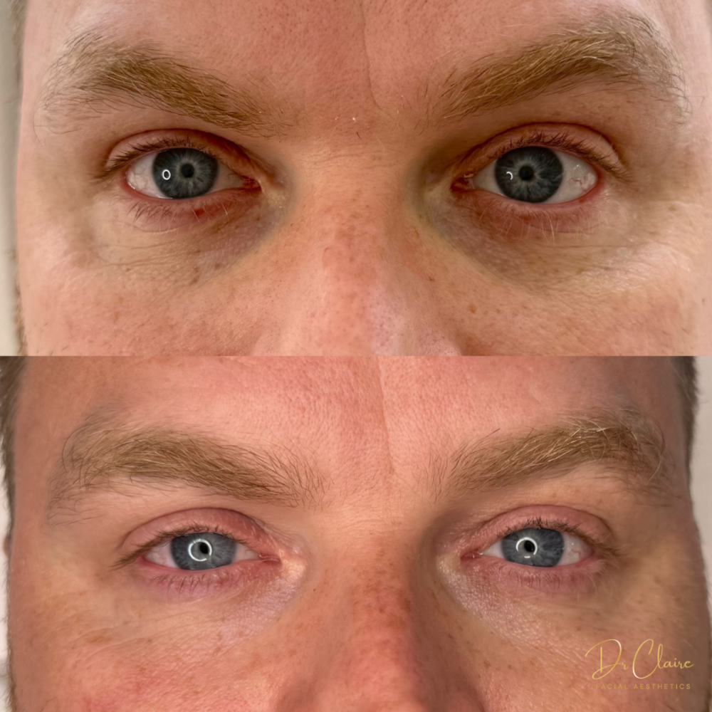 Transformations | Dr Claire Facial Aesthetics | Botox Chorley | Fillers Chorley | Aesthetics Chorley | Botox Treatments Chorley | Dermal Fillers Chorley | Aesthetic Enhancements Chorley