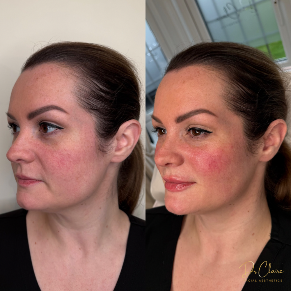 Transformations | Dr Claire Facial Aesthetics | Botox Chorley | Fillers Chorley | Aesthetics Chorley | Botox Treatments Chorley | Dermal Fillers Chorley | Aesthetic Enhancements Chorley