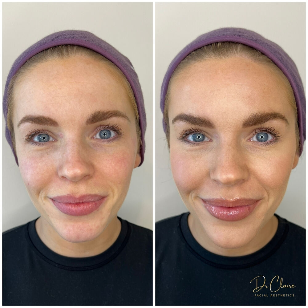 Transformations | Dr Claire Facial Aesthetics | Botox Chorley | Fillers Chorley | Aesthetics Chorley | Botox Treatments Chorley | Dermal Fillers Chorley | Aesthetic Enhancements Chorley