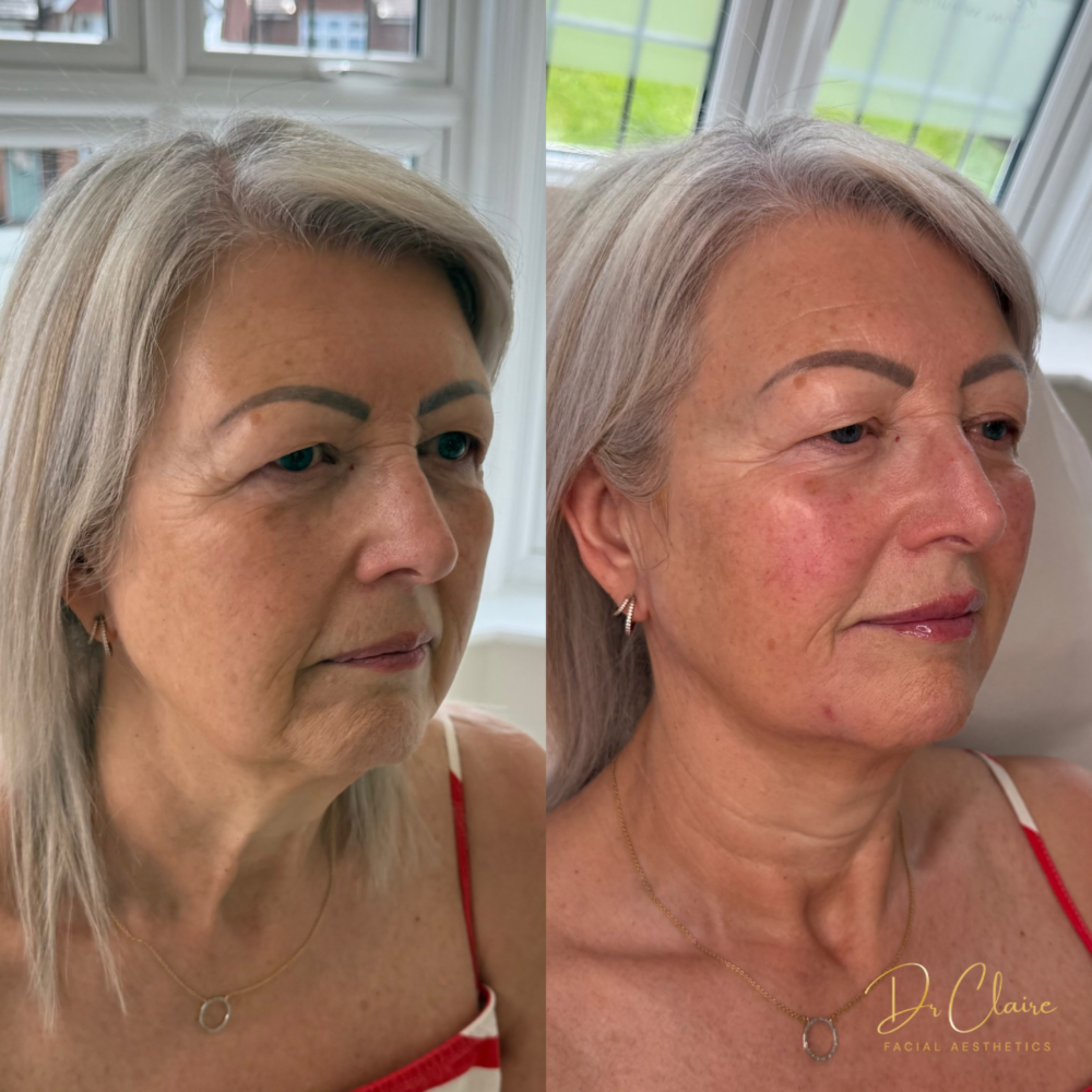 Transformations | Dr Claire Facial Aesthetics | Botox Chorley | Fillers Chorley | Aesthetics Chorley | Botox Treatments Chorley | Dermal Fillers Chorley | Aesthetic Enhancements Chorley