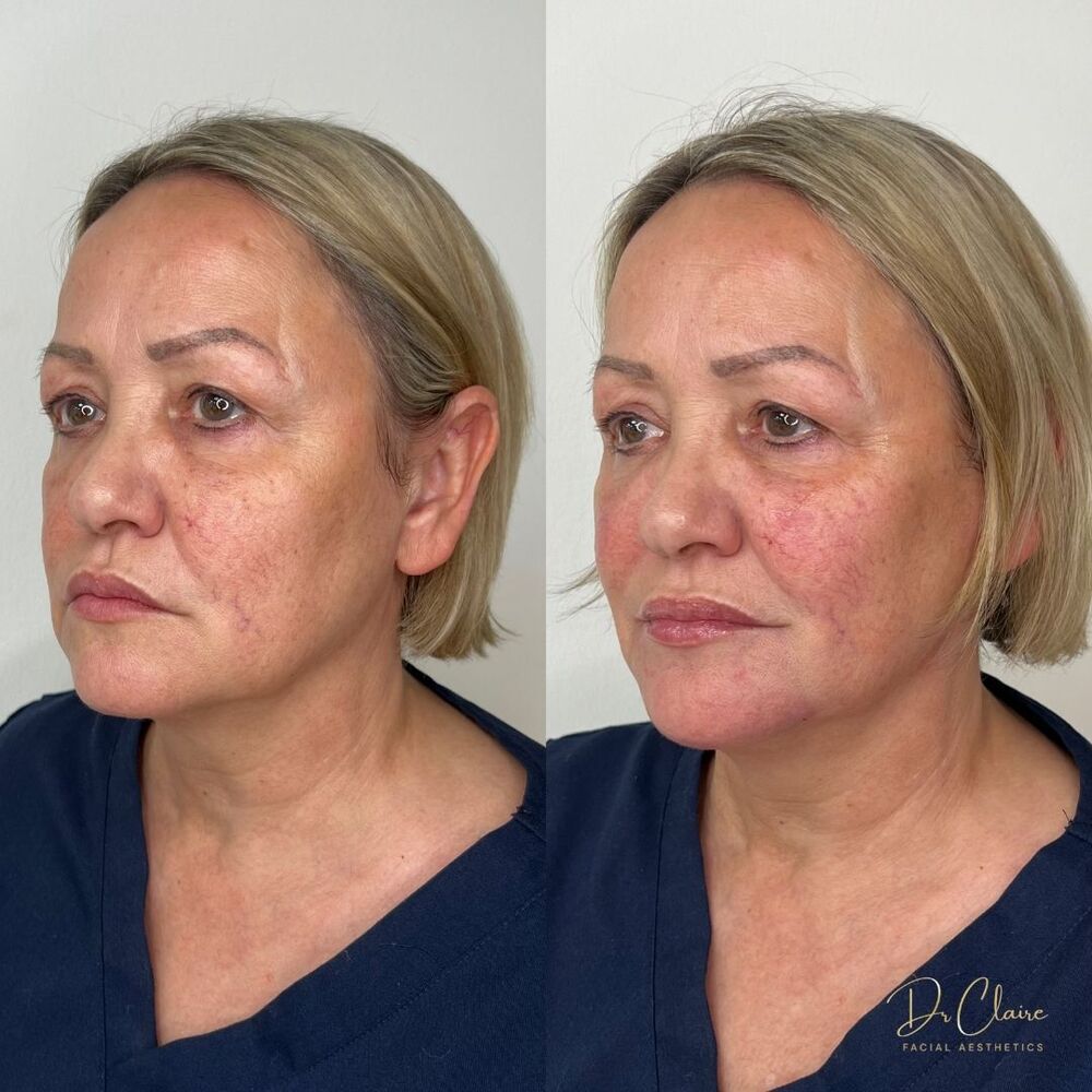 Transformations | Dr Claire Facial Aesthetics | Botox Chorley | Fillers Chorley | Aesthetics Chorley | Botox Treatments Chorley | Dermal Fillers Chorley | Aesthetic Enhancements Chorley