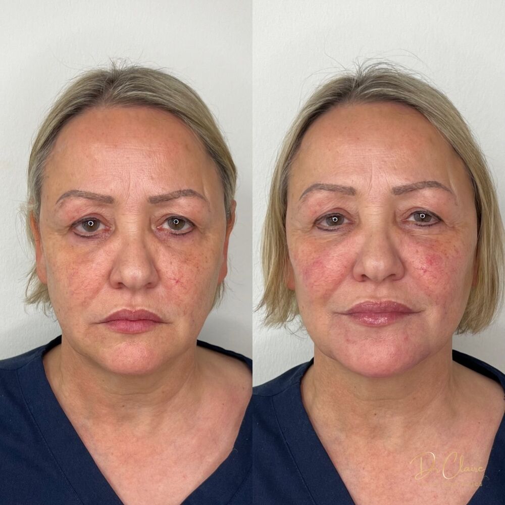 Transformations | Dr Claire Facial Aesthetics | Botox Chorley | Fillers Chorley | Aesthetics Chorley | Botox Treatments Chorley | Dermal Fillers Chorley | Aesthetic Enhancements Chorley