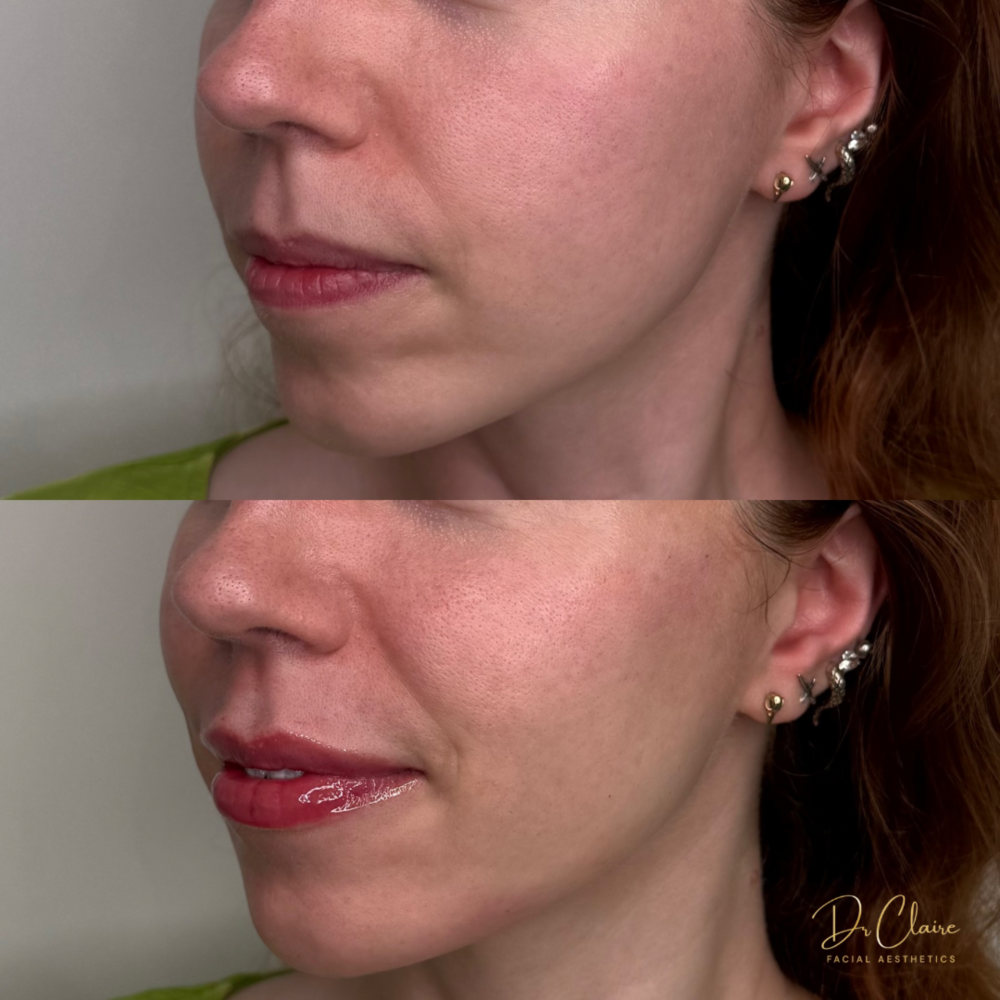 Transformations | Dr Claire Facial Aesthetics | Botox Chorley | Fillers Chorley | Aesthetics Chorley | Botox Treatments Chorley | Dermal Fillers Chorley | Aesthetic Enhancements Chorley