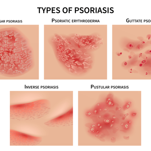 psoriasis awareness month