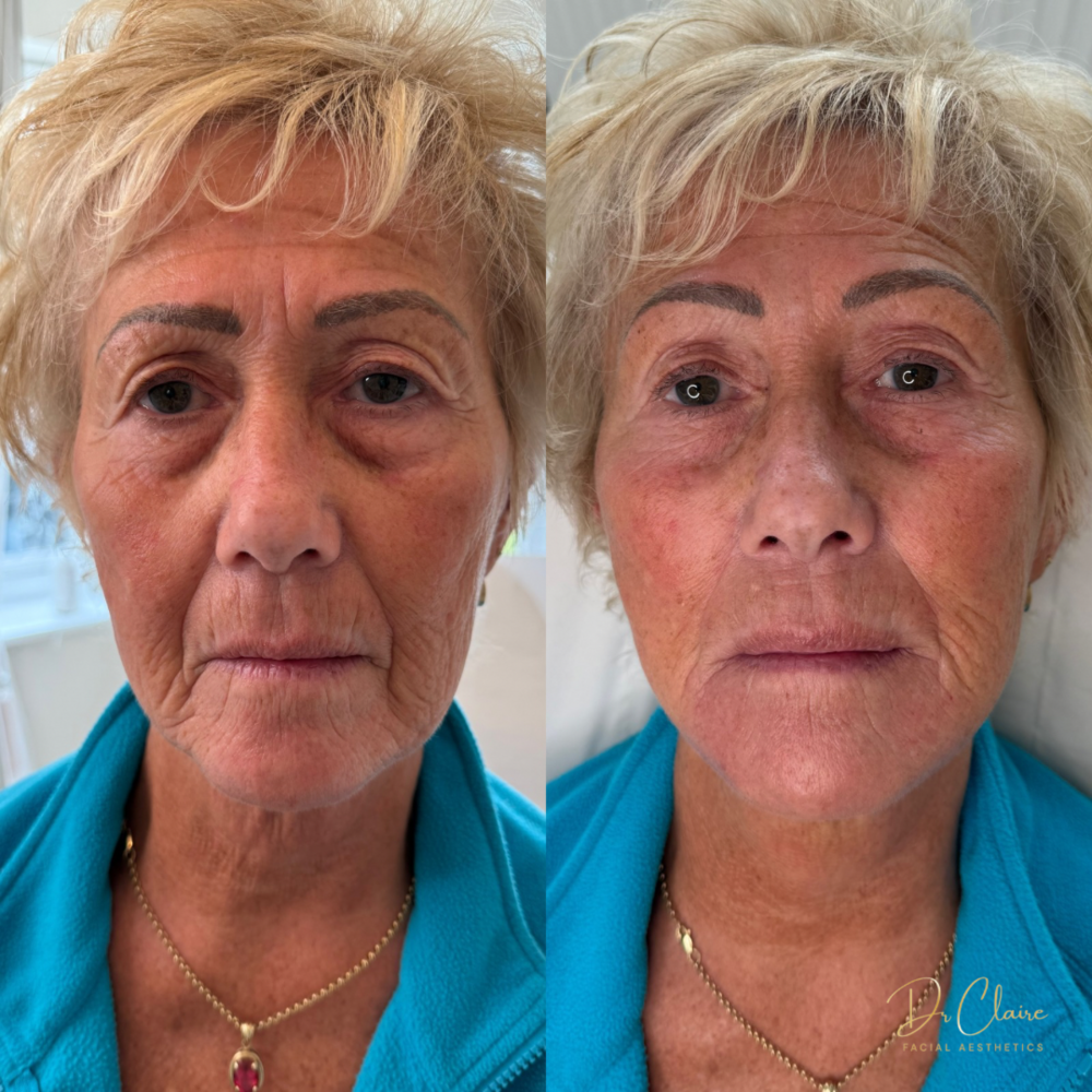 Transformations | Dr Claire Facial Aesthetics | Botox Chorley | Fillers Chorley | Aesthetics Chorley | Botox Treatments Chorley | Dermal Fillers Chorley | Aesthetic Enhancements Chorley