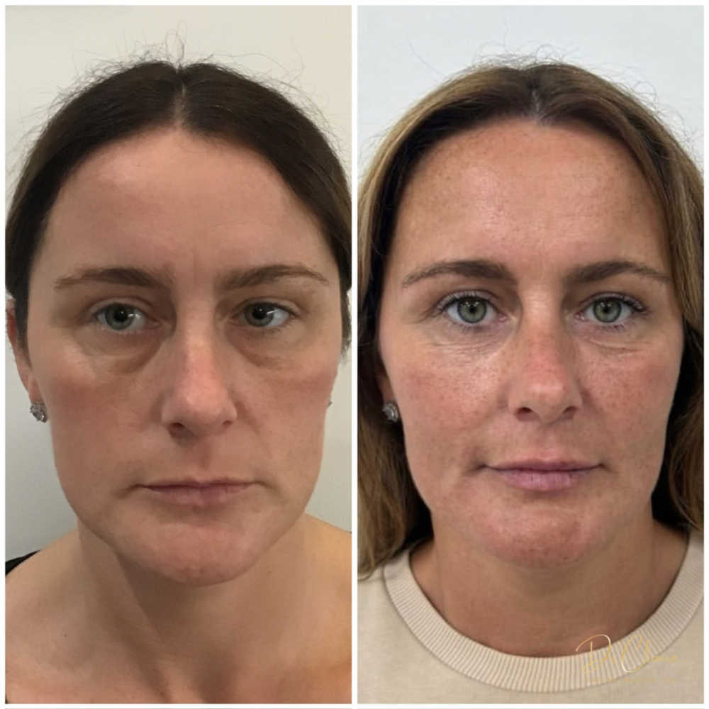 Transformations | Dr Claire Facial Aesthetics | Botox Chorley | Fillers Chorley | Aesthetics Chorley | Botox Treatments Chorley | Dermal Fillers Chorley | Aesthetic Enhancements Chorley