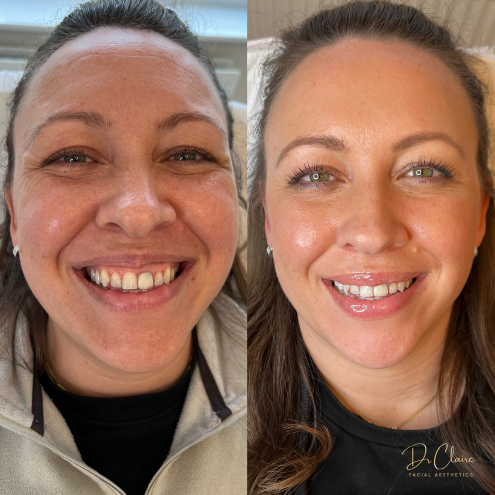 Transformations | Dr Claire Facial Aesthetics | Botox Chorley | Fillers Chorley | Aesthetics Chorley | Botox Treatments Chorley | Dermal Fillers Chorley | Aesthetic Enhancements Chorley