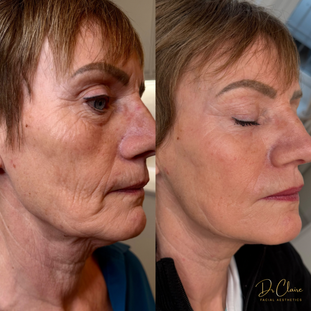 Transformations | Dr Claire Facial Aesthetics | Botox Chorley | Fillers Chorley | Aesthetics Chorley | Botox Treatments Chorley | Dermal Fillers Chorley | Aesthetic Enhancements Chorley