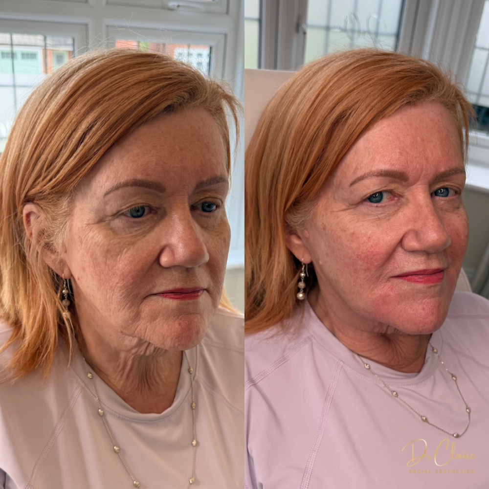 Transformations | Dr Claire Facial Aesthetics | Botox Chorley | Fillers Chorley | Aesthetics Chorley | Botox Treatments Chorley | Dermal Fillers Chorley | Aesthetic Enhancements Chorley