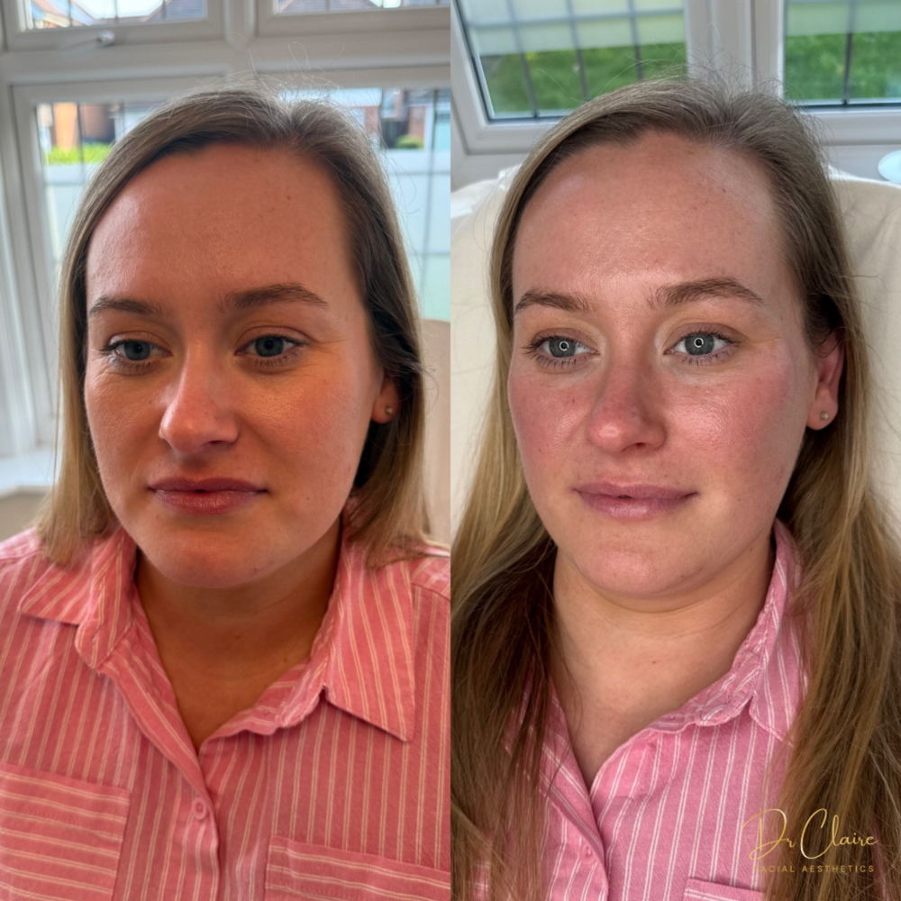 Transformations | Dr Claire Facial Aesthetics | Botox Chorley | Fillers Chorley | Aesthetics Chorley | Botox Treatments Chorley | Dermal Fillers Chorley | Aesthetic Enhancements Chorley