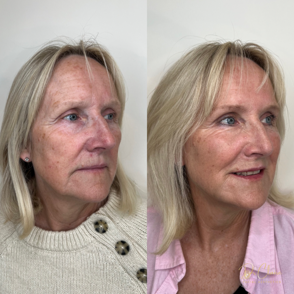 Transformations | Dr Claire Facial Aesthetics | Botox Chorley | Fillers Chorley | Aesthetics Chorley | Botox Treatments Chorley | Dermal Fillers Chorley | Aesthetic Enhancements Chorley