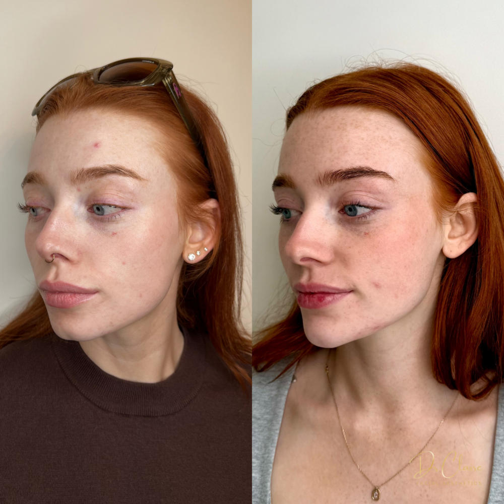 Transformations | Dr Claire Facial Aesthetics | Botox Chorley | Fillers Chorley | Aesthetics Chorley | Botox Treatments Chorley | Dermal Fillers Chorley | Aesthetic Enhancements Chorley