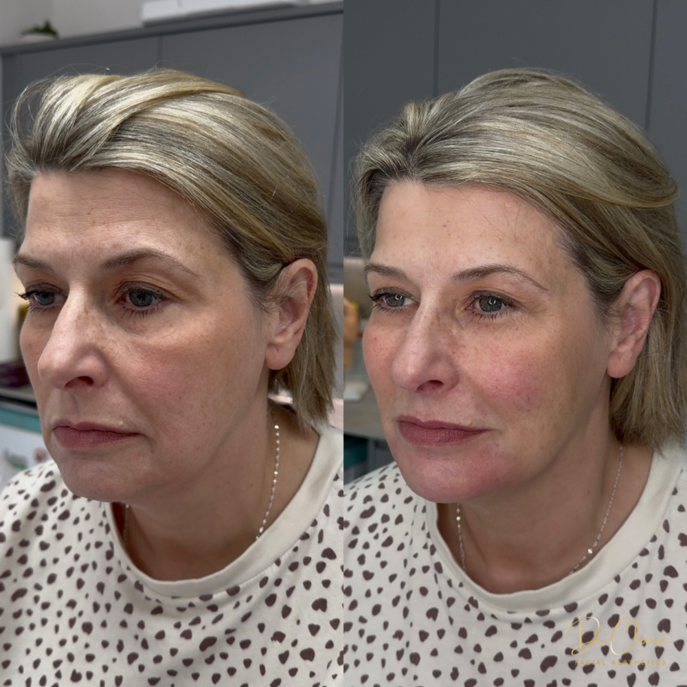 Transformations | Dr Claire Facial Aesthetics | Botox Chorley | Fillers Chorley | Aesthetics Chorley | Botox Treatments Chorley | Dermal Fillers Chorley | Aesthetic Enhancements Chorley