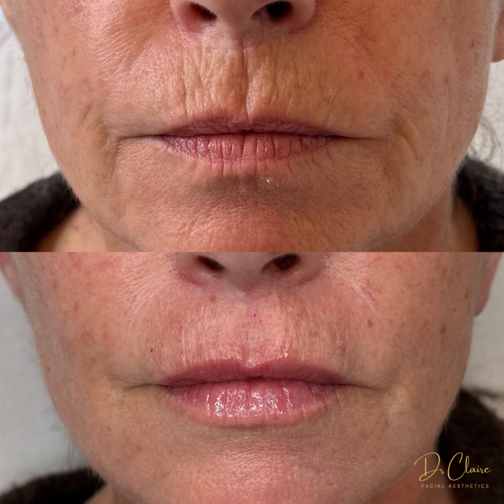 Transformations | Dr Claire Facial Aesthetics | Botox Chorley | Fillers Chorley | Aesthetics Chorley | Botox Treatments Chorley | Dermal Fillers Chorley | Aesthetic Enhancements Chorley