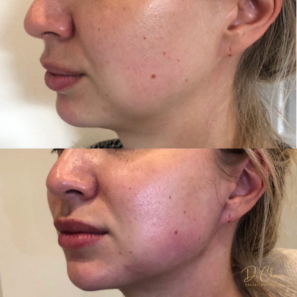 Transformations | Dr Claire Facial Aesthetics | Botox Chorley | Fillers Chorley | Aesthetics Chorley | Botox Treatments Chorley | Dermal Fillers Chorley | Aesthetic Enhancements Chorley
