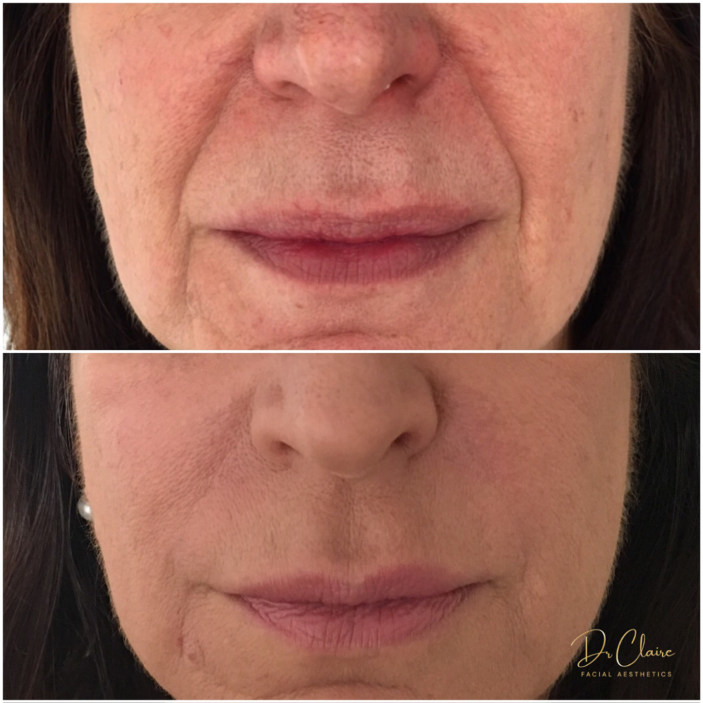 Transformations | Dr Claire Facial Aesthetics | Botox Chorley | Fillers Chorley | Aesthetics Chorley | Botox Treatments Chorley | Dermal Fillers Chorley | Aesthetic Enhancements Chorley