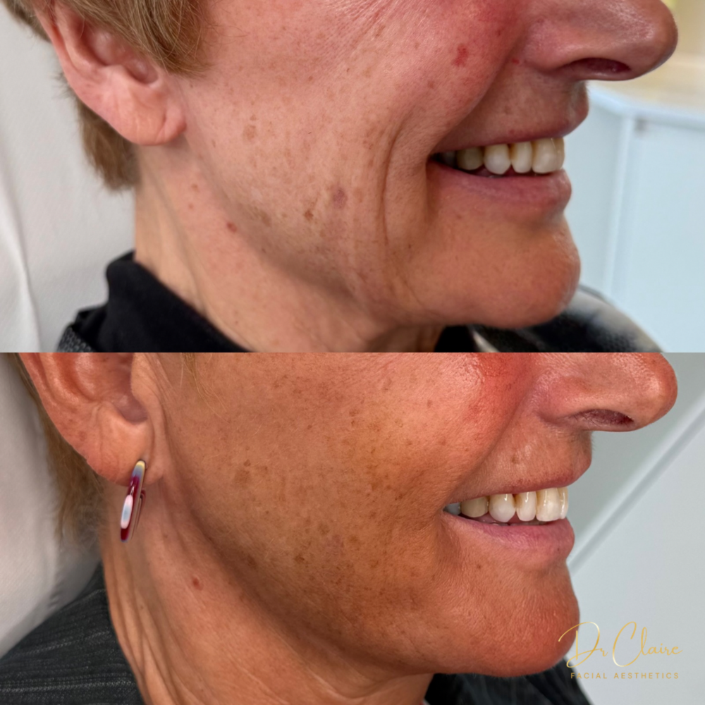 Transformations | Dr Claire Facial Aesthetics | Botox Chorley | Fillers Chorley | Aesthetics Chorley | Botox Treatments Chorley | Dermal Fillers Chorley | Aesthetic Enhancements Chorley