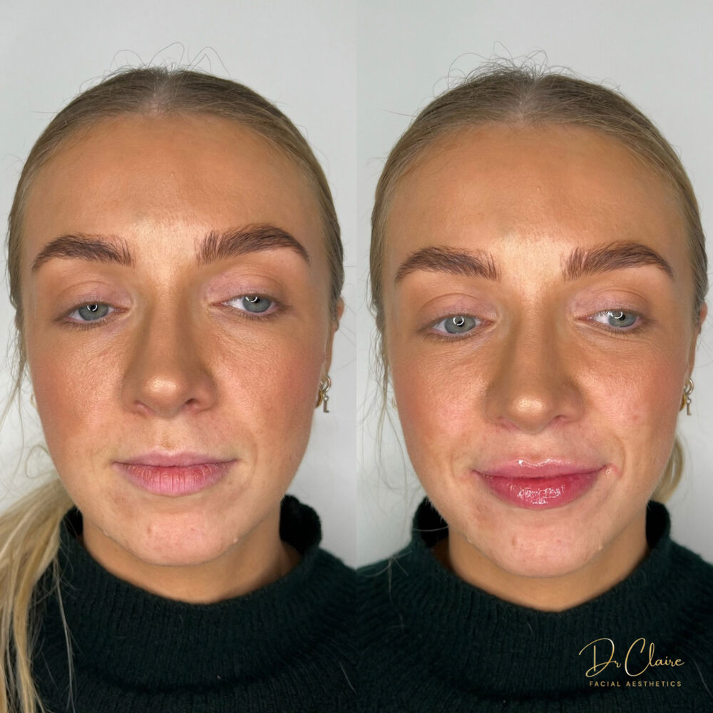 Transformations | Dr Claire Facial Aesthetics | Botox Chorley | Fillers Chorley | Aesthetics Chorley | Botox Treatments Chorley | Dermal Fillers Chorley | Aesthetic Enhancements Chorley