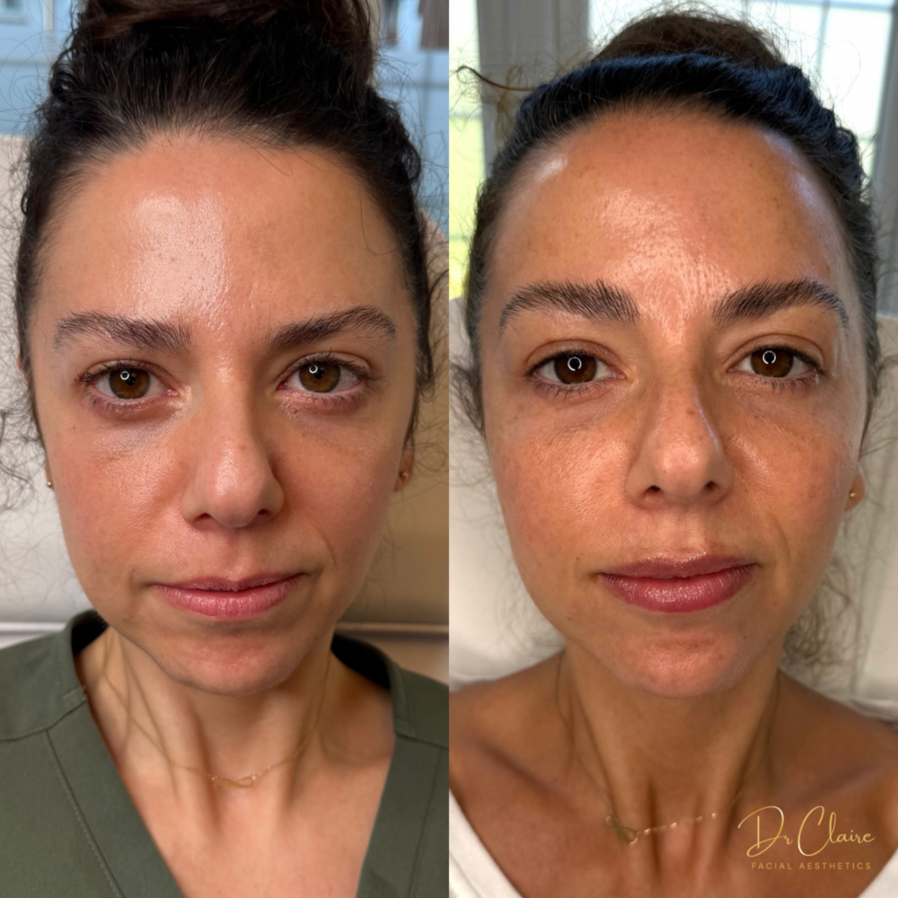 Transformations | Dr Claire Facial Aesthetics | Botox Chorley | Fillers Chorley | Aesthetics Chorley | Botox Treatments Chorley | Dermal Fillers Chorley | Aesthetic Enhancements Chorley