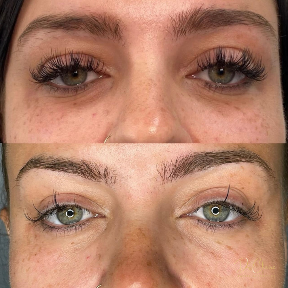Transformations | Dr Claire Facial Aesthetics | Botox Chorley | Fillers Chorley | Aesthetics Chorley | Botox Treatments Chorley | Dermal Fillers Chorley | Aesthetic Enhancements Chorley