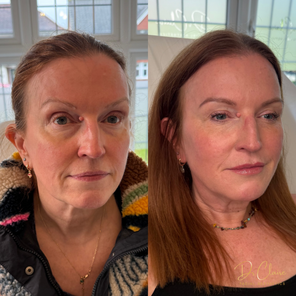 Transformations | Dr Claire Facial Aesthetics | Botox Chorley | Fillers Chorley | Aesthetics Chorley | Botox Treatments Chorley | Dermal Fillers Chorley | Aesthetic Enhancements Chorley