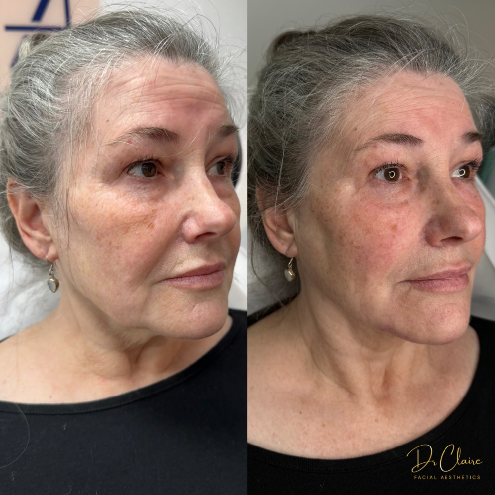 Transformations | Dr Claire Facial Aesthetics | Botox Chorley | Fillers Chorley | Aesthetics Chorley | Botox Treatments Chorley | Dermal Fillers Chorley | Aesthetic Enhancements Chorley