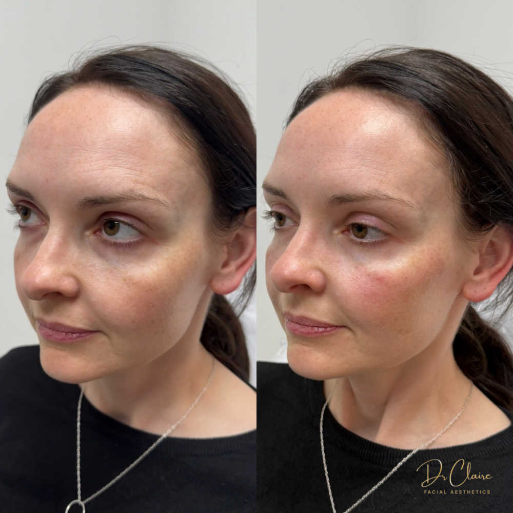 Transformations | Dr Claire Facial Aesthetics | Botox Chorley | Fillers Chorley | Aesthetics Chorley | Botox Treatments Chorley | Dermal Fillers Chorley | Aesthetic Enhancements Chorley