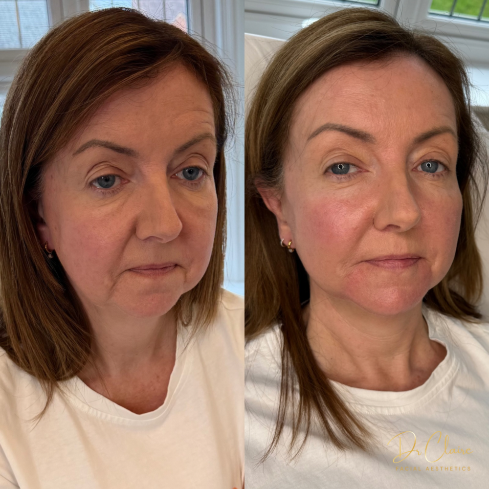 Transformations | Dr Claire Facial Aesthetics | Botox Chorley | Fillers Chorley | Aesthetics Chorley | Botox Treatments Chorley | Dermal Fillers Chorley | Aesthetic Enhancements Chorley