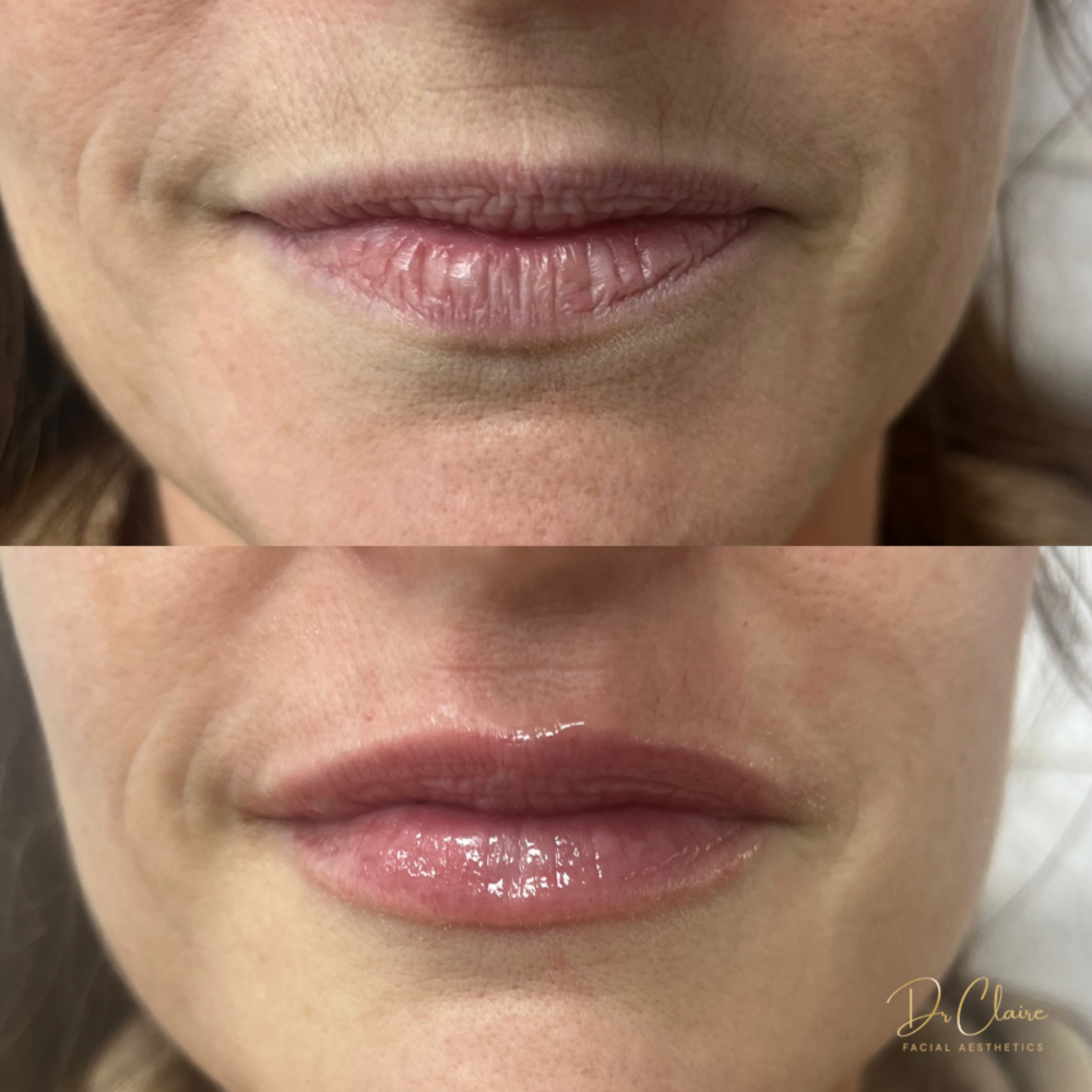 Transformations | Dr Claire Facial Aesthetics | Botox Chorley | Fillers Chorley | Aesthetics Chorley | Botox Treatments Chorley | Dermal Fillers Chorley | Aesthetic Enhancements Chorley