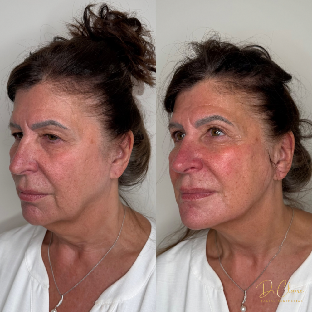 Transformations | Dr Claire Facial Aesthetics | Botox Chorley | Fillers Chorley | Aesthetics Chorley | Botox Treatments Chorley | Dermal Fillers Chorley | Aesthetic Enhancements Chorley