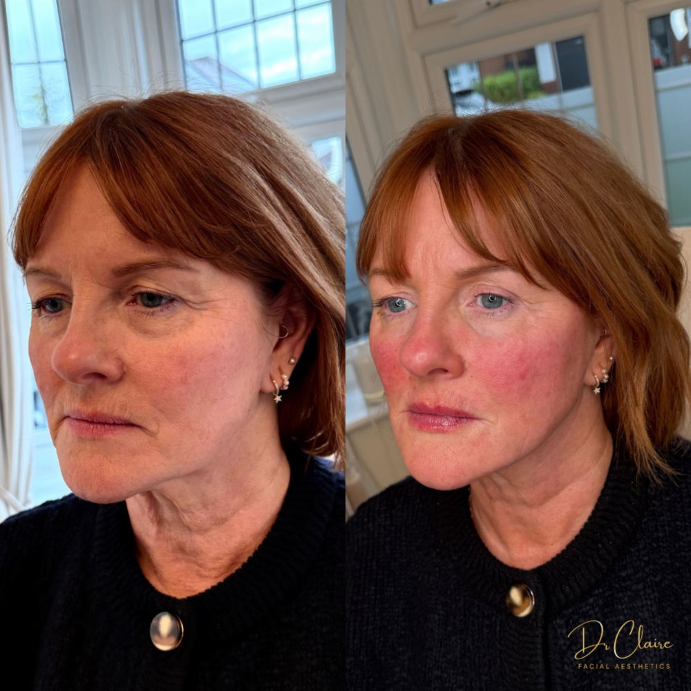 Transformations | Dr Claire Facial Aesthetics | Botox Chorley | Fillers Chorley | Aesthetics Chorley | Botox Treatments Chorley | Dermal Fillers Chorley | Aesthetic Enhancements Chorley