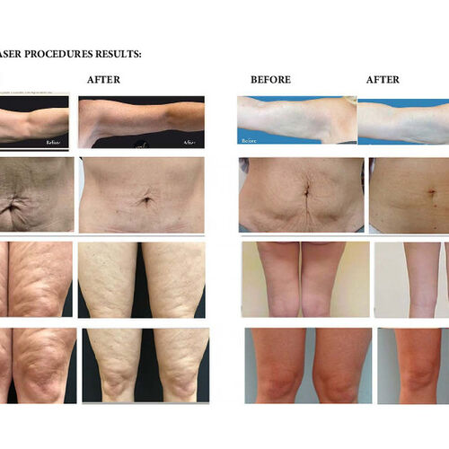 Endo lift /Endolaser results  | The Tx Room / medical wellness and skin clinic/endolift/endolaser