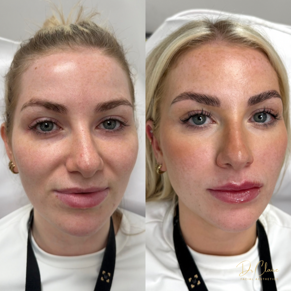Transformations | Dr Claire Facial Aesthetics | Botox Chorley | Fillers Chorley | Aesthetics Chorley | Botox Treatments Chorley | Dermal Fillers Chorley | Aesthetic Enhancements Chorley
