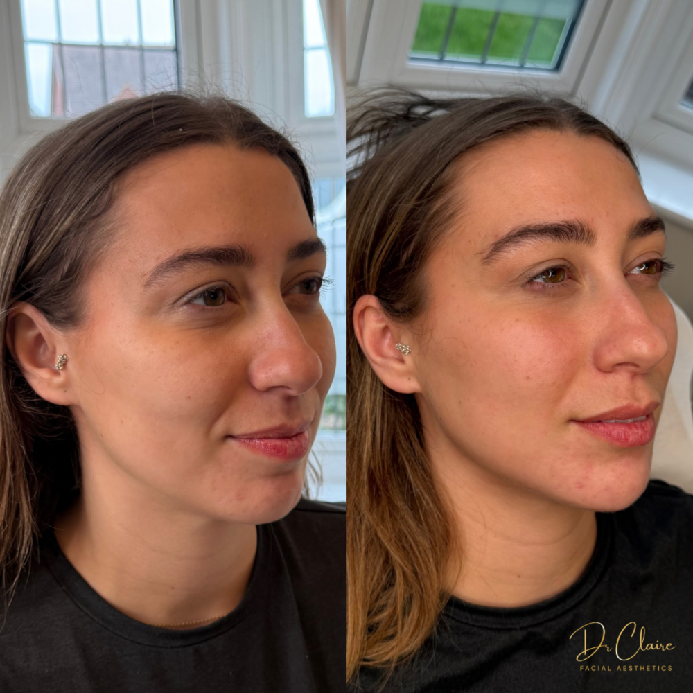 Transformations | Dr Claire Facial Aesthetics | Botox Chorley | Fillers Chorley | Aesthetics Chorley | Botox Treatments Chorley | Dermal Fillers Chorley | Aesthetic Enhancements Chorley