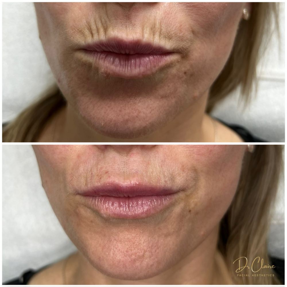 Transformations | Dr Claire Facial Aesthetics | Botox Chorley | Fillers Chorley | Aesthetics Chorley | Botox Treatments Chorley | Dermal Fillers Chorley | Aesthetic Enhancements Chorley