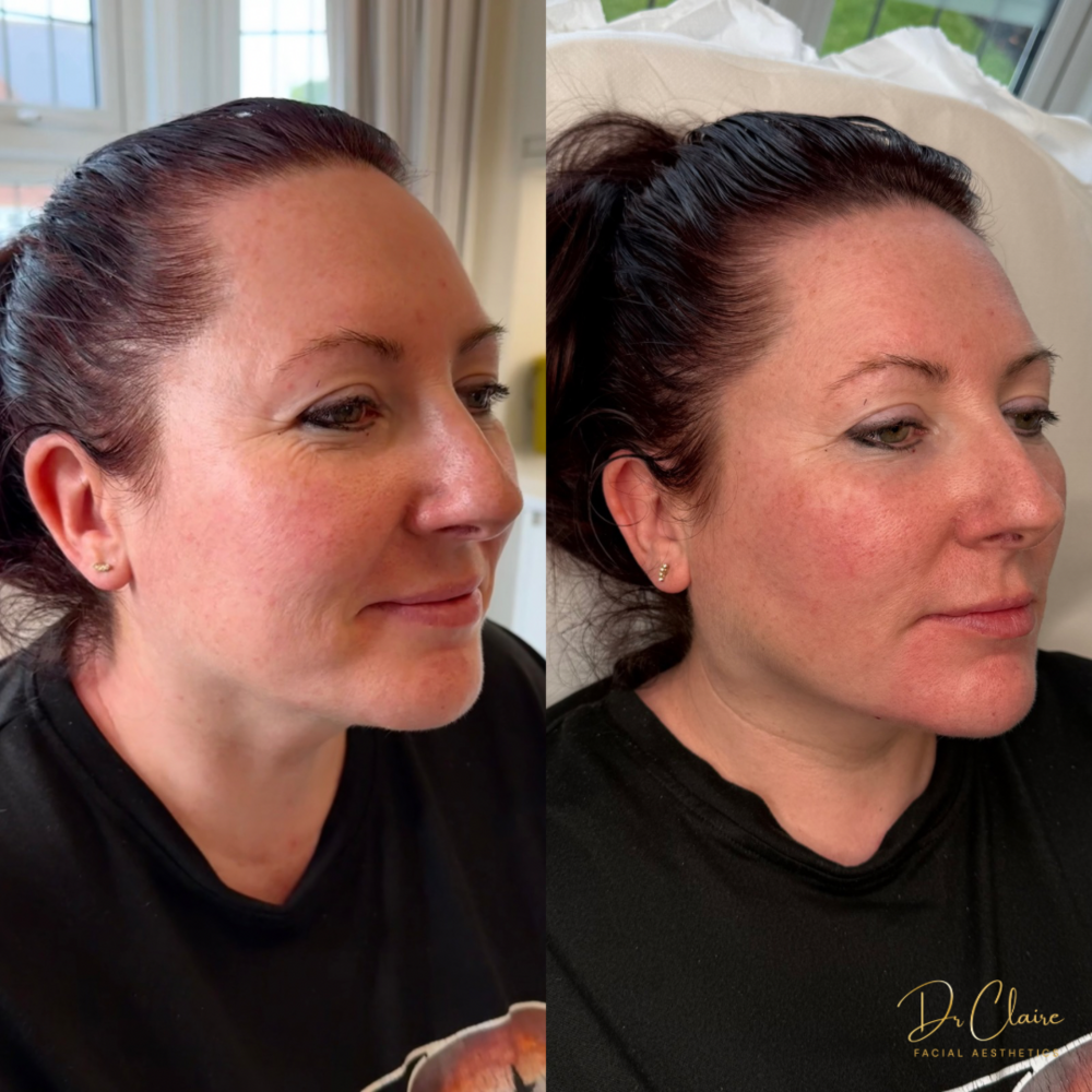 Transformations | Dr Claire Facial Aesthetics | Botox Chorley | Fillers Chorley | Aesthetics Chorley | Botox Treatments Chorley | Dermal Fillers Chorley | Aesthetic Enhancements Chorley
