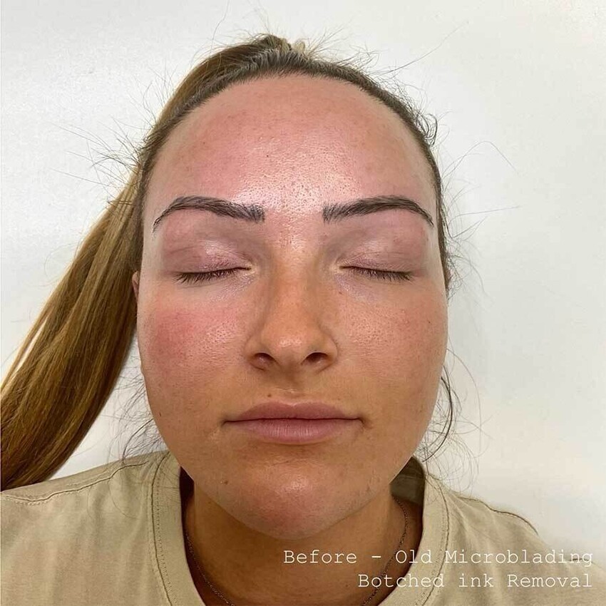 Tattoo Removal - Botched Ink