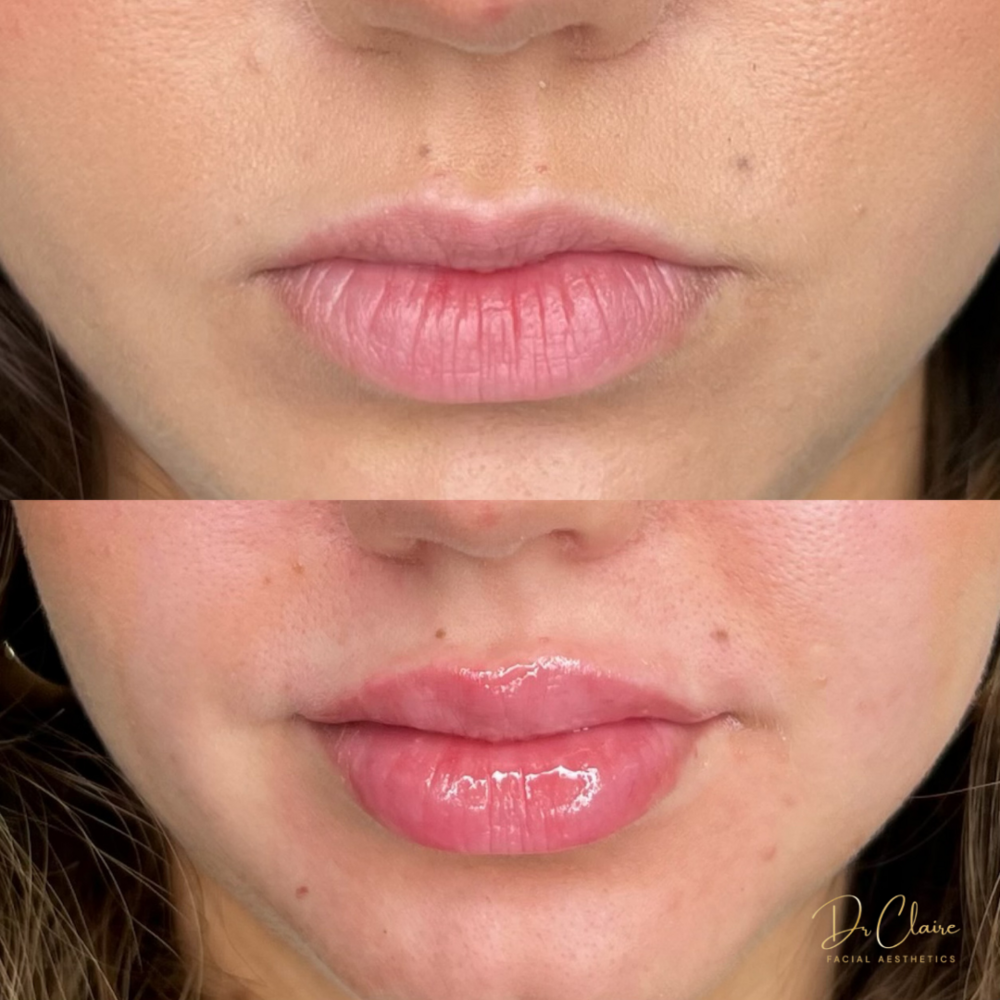 Transformations | Dr Claire Facial Aesthetics | Botox Chorley | Fillers Chorley | Aesthetics Chorley | Botox Treatments Chorley | Dermal Fillers Chorley | Aesthetic Enhancements Chorley