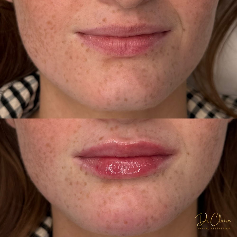 Transformations | Dr Claire Facial Aesthetics | Botox Chorley | Fillers Chorley | Aesthetics Chorley | Botox Treatments Chorley | Dermal Fillers Chorley | Aesthetic Enhancements Chorley