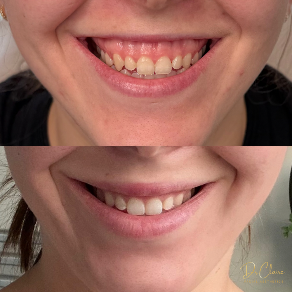Transformations | Dr Claire Facial Aesthetics | Botox Chorley | Fillers Chorley | Aesthetics Chorley | Botox Treatments Chorley | Dermal Fillers Chorley | Aesthetic Enhancements Chorley