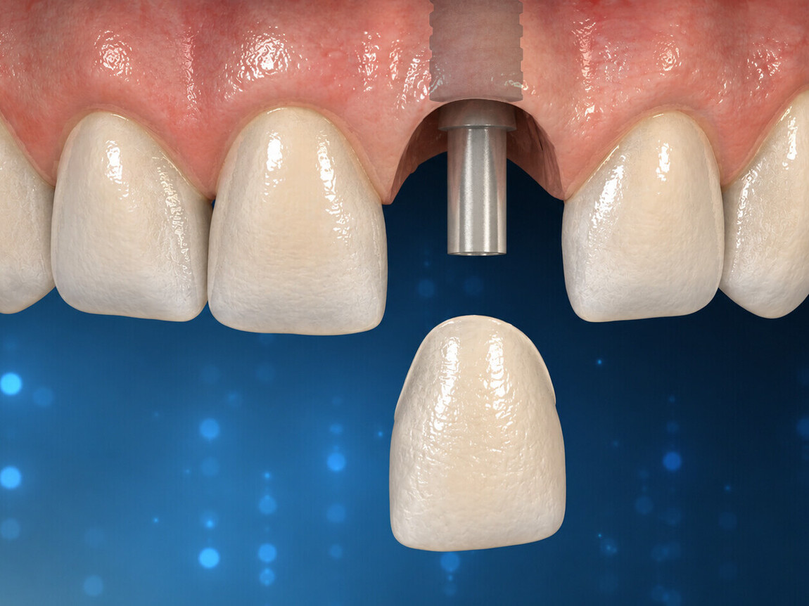 Dental Implants | Cramond House Dental Practice | Dentist Clitheroe Preston Manchester | Dental Implants Clitheroe Preston Manchester | Gum Surgery Clitheroe Preston Manchester