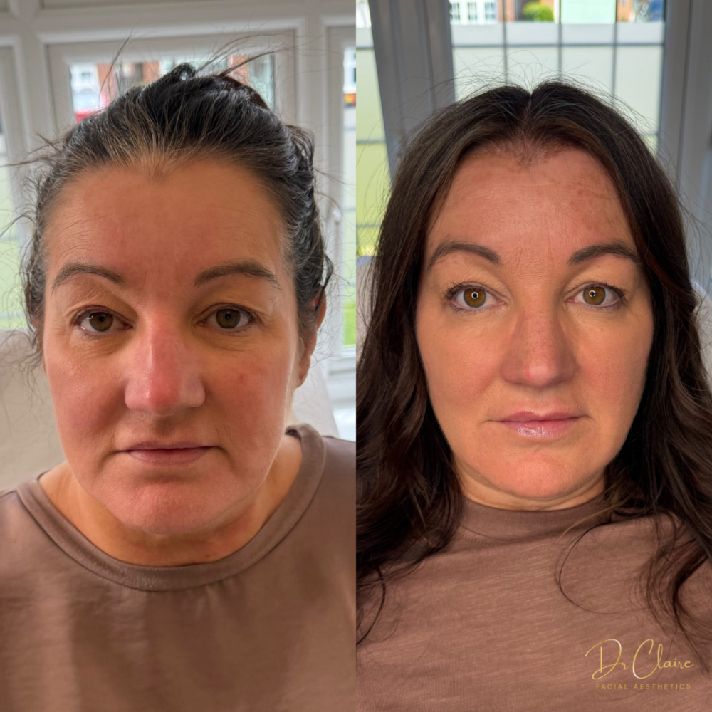 Transformations | Dr Claire Facial Aesthetics | Botox Chorley | Fillers Chorley | Aesthetics Chorley | Botox Treatments Chorley | Dermal Fillers Chorley | Aesthetic Enhancements Chorley