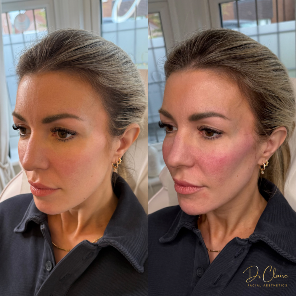 Transformations | Dr Claire Facial Aesthetics | Botox Chorley | Fillers Chorley | Aesthetics Chorley | Botox Treatments Chorley | Dermal Fillers Chorley | Aesthetic Enhancements Chorley