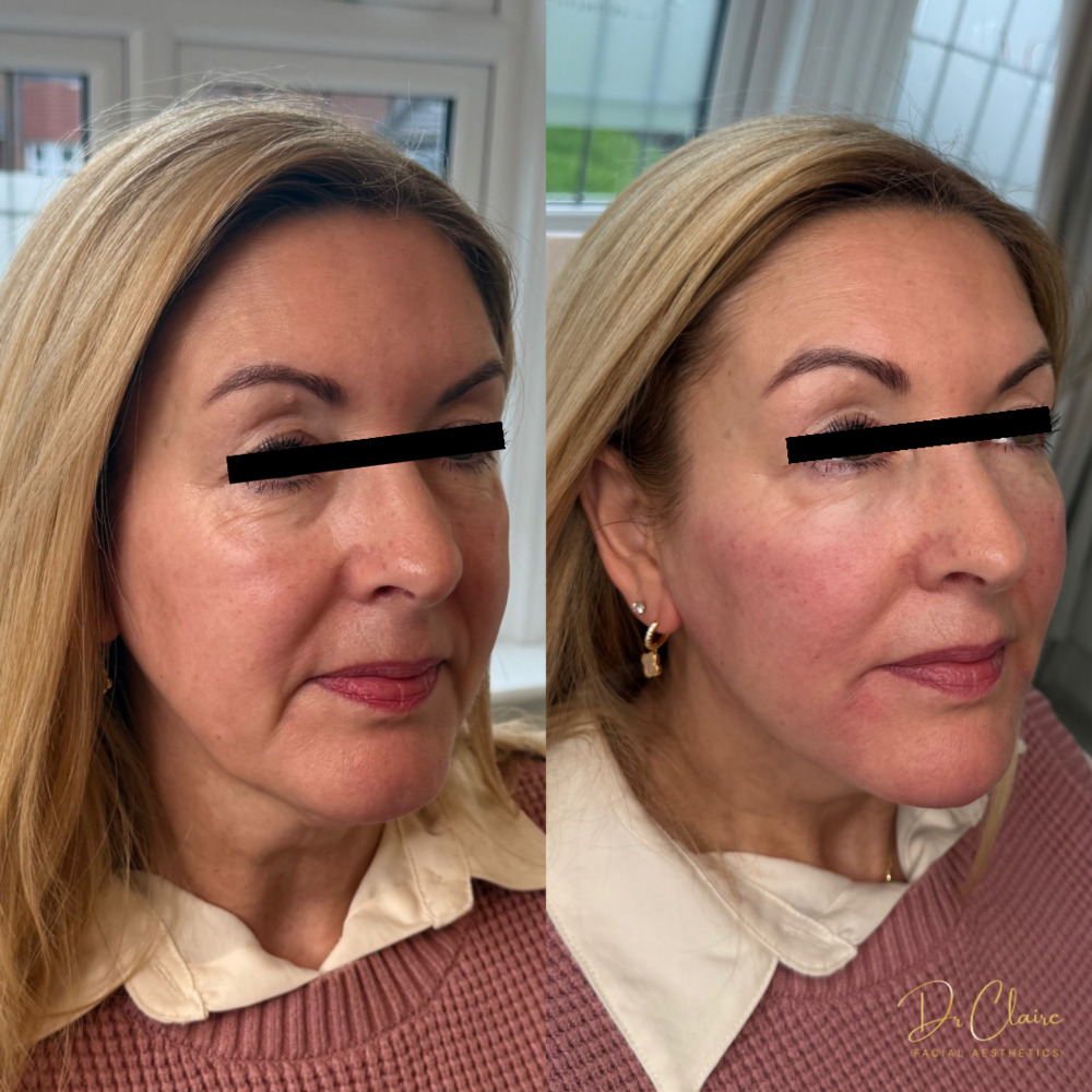 Transformations | Dr Claire Facial Aesthetics | Botox Chorley | Fillers Chorley | Aesthetics Chorley | Botox Treatments Chorley | Dermal Fillers Chorley | Aesthetic Enhancements Chorley
