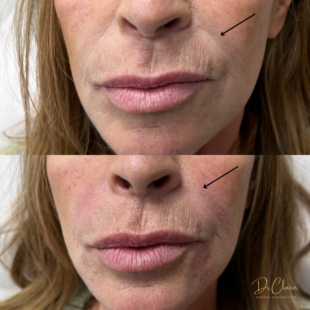 Transformations | Dr Claire Facial Aesthetics | Botox Chorley | Fillers Chorley | Aesthetics Chorley | Botox Treatments Chorley | Dermal Fillers Chorley | Aesthetic Enhancements Chorley