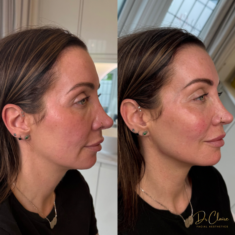 Transformations | Dr Claire Facial Aesthetics | Botox Chorley | Fillers Chorley | Aesthetics Chorley | Botox Treatments Chorley | Dermal Fillers Chorley | Aesthetic Enhancements Chorley