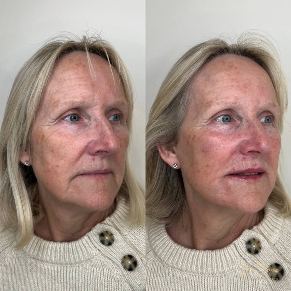 Transformations | Dr Claire Facial Aesthetics | Botox Chorley | Fillers Chorley | Aesthetics Chorley | Botox Treatments Chorley | Dermal Fillers Chorley | Aesthetic Enhancements Chorley