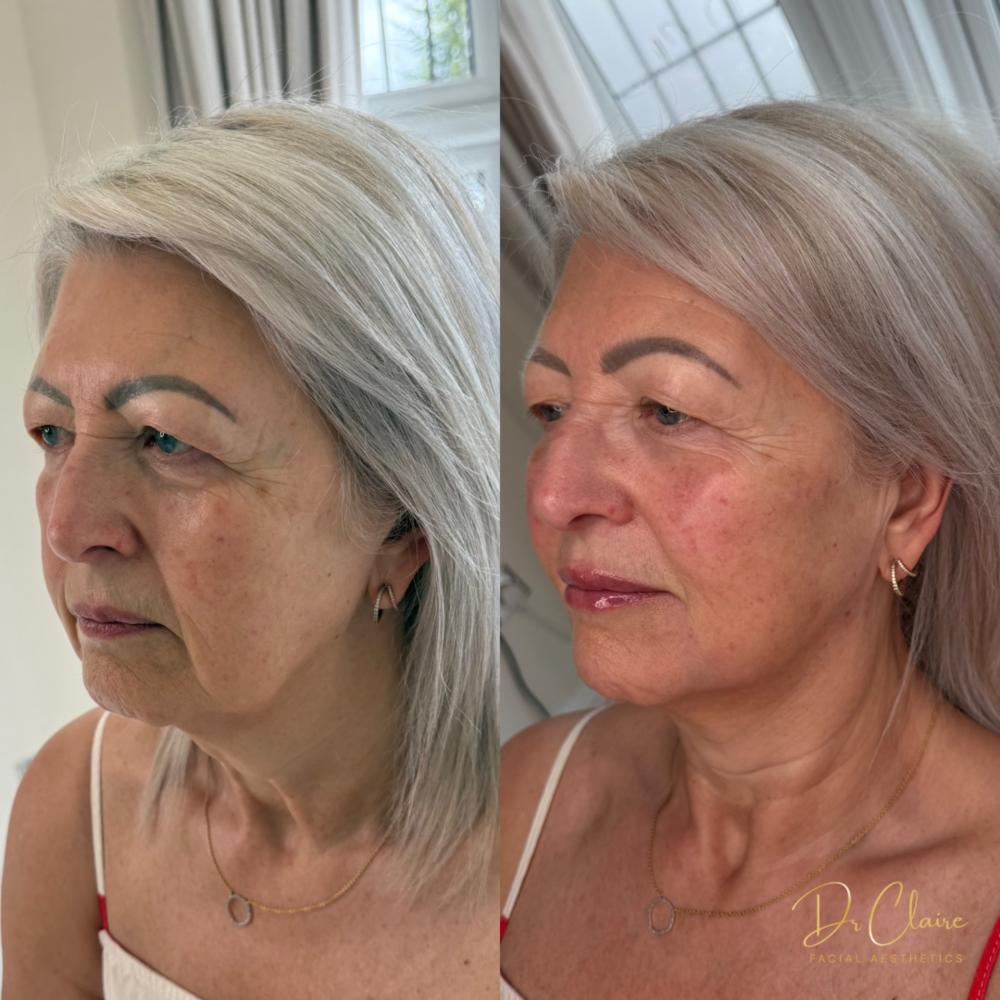 Transformations | Dr Claire Facial Aesthetics | Botox Chorley | Fillers Chorley | Aesthetics Chorley | Botox Treatments Chorley | Dermal Fillers Chorley | Aesthetic Enhancements Chorley