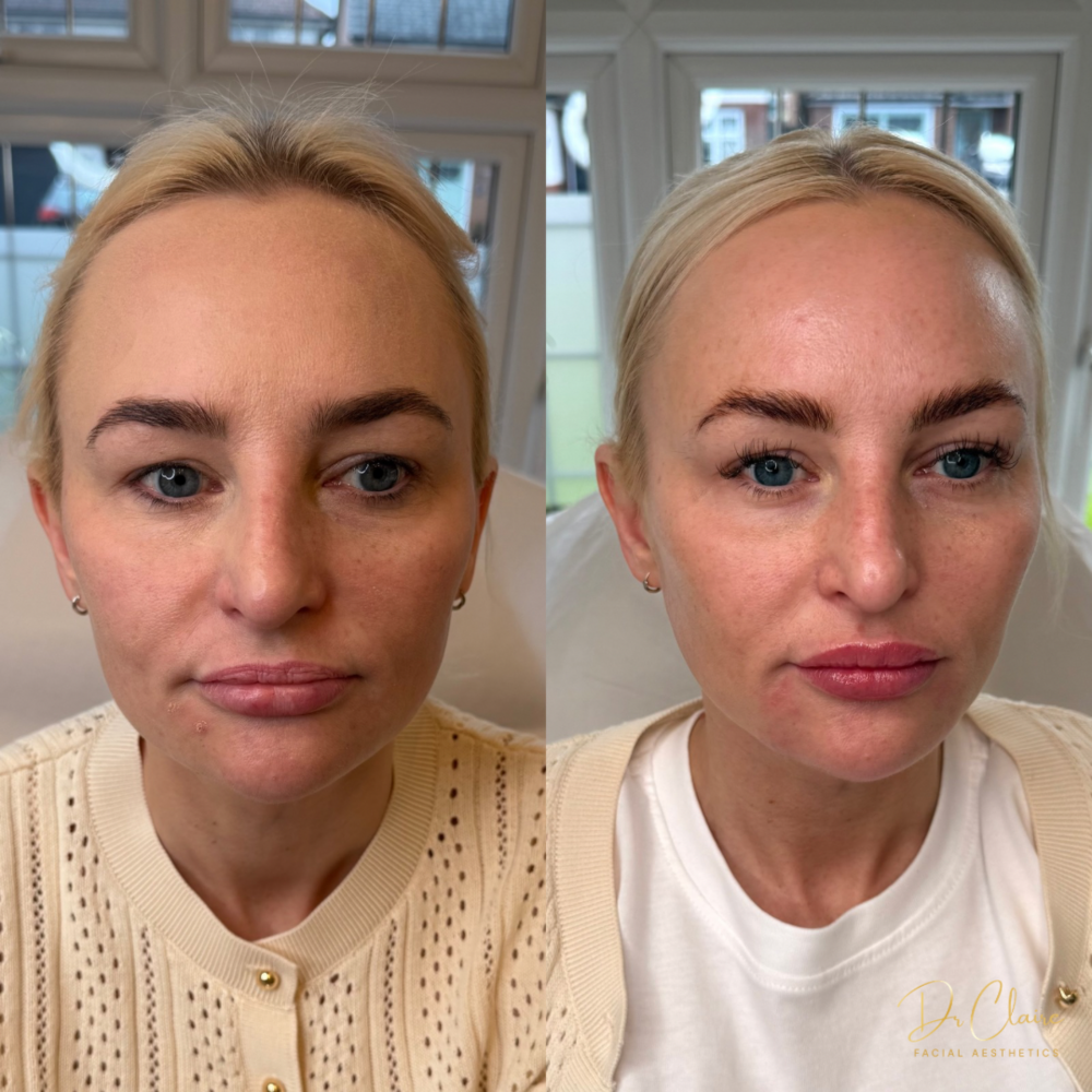 Transformations | Dr Claire Facial Aesthetics | Botox Chorley | Fillers Chorley | Aesthetics Chorley | Botox Treatments Chorley | Dermal Fillers Chorley | Aesthetic Enhancements Chorley