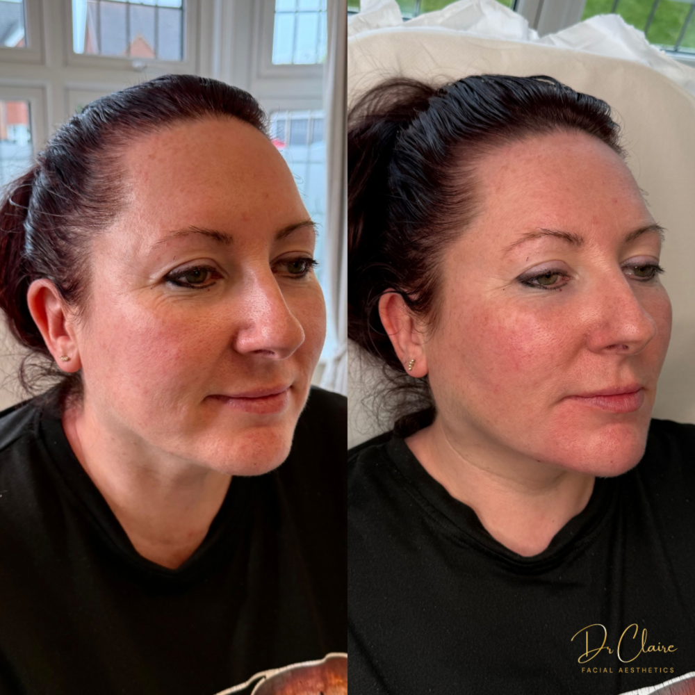 Transformations | Dr Claire Facial Aesthetics | Botox Chorley | Fillers Chorley | Aesthetics Chorley | Botox Treatments Chorley | Dermal Fillers Chorley | Aesthetic Enhancements Chorley